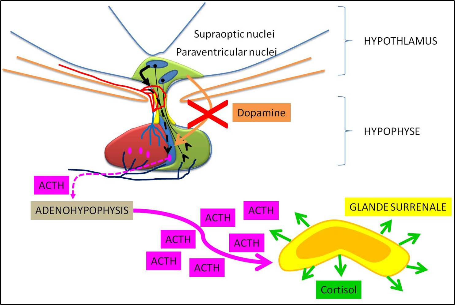 L'inhibition de la sécrétion de dopamine par l'hypothalamus provoque un excès de libération d'ACTH par l'hypophyse.